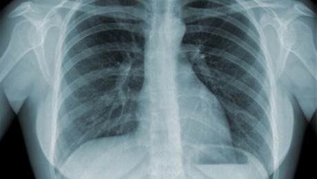 Global Tuberculosis (TB) Clinical Management and Research course image